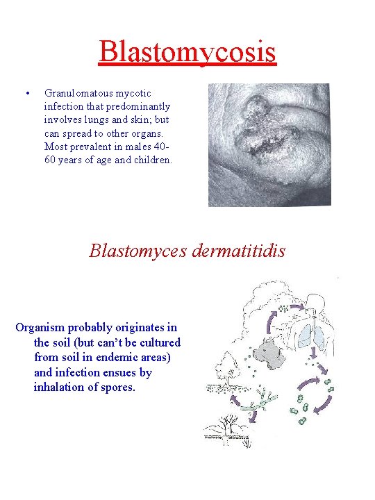 Blastomycosis • Granulomatous mycotic infection that predominantly involves lungs and skin; but can spread