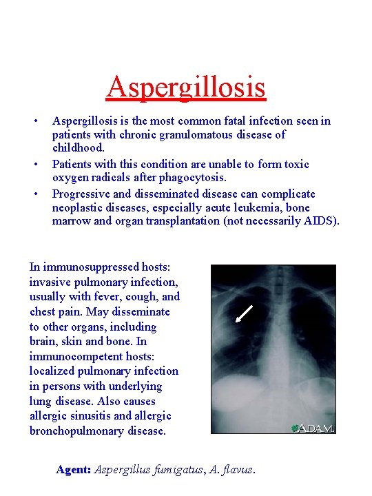 Aspergillosis • • • Aspergillosis is the most common fatal infection seen in patients