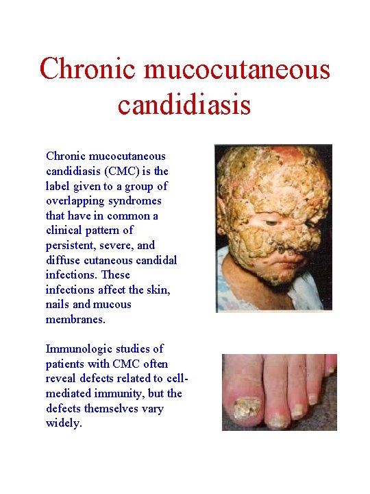 Chronic mucocutaneous candidiasis (CMC) is the label given to a group of overlapping syndromes