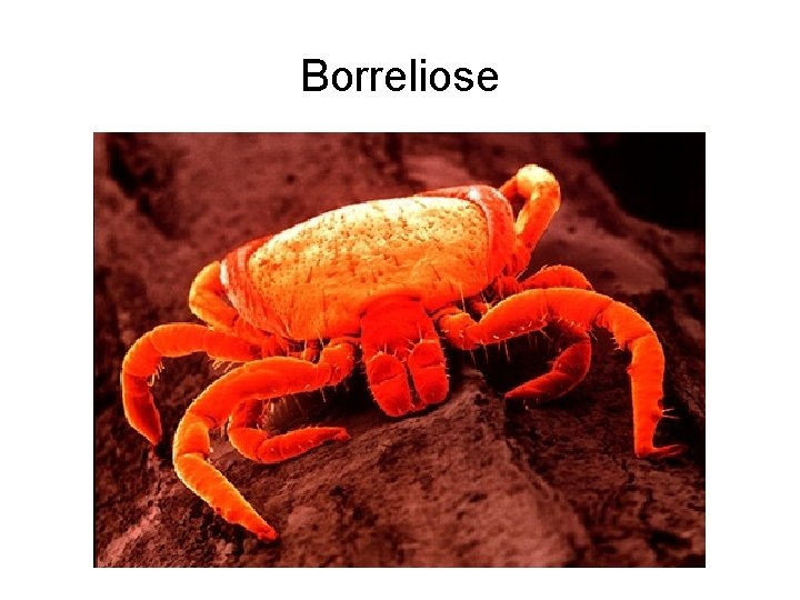 Borreliose 