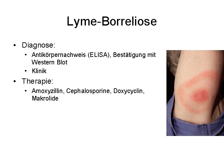 Lyme-Borreliose • Diagnose: • Antikörpernachweis (ELISA), Bestätigung mit Western Blot • Klinik • Therapie: