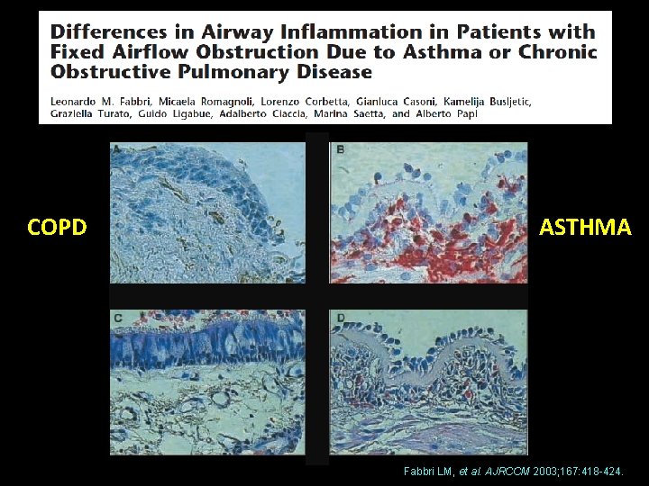 COPD ASTHMA Fabbri LM, et al. AJRCCM 2003; 167: 418 -424. 