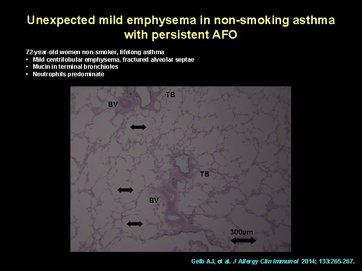 Unexpected mild emphysema in non-smoking asthma with persistent AFO 72 -year-old women non-smoker, lifelong