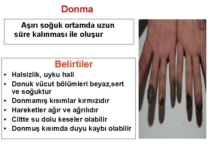 Donma Aşırı soğuk ortamda uzun süre kalınması ile oluşur Belirtiler • Halsizlik, uyku hali