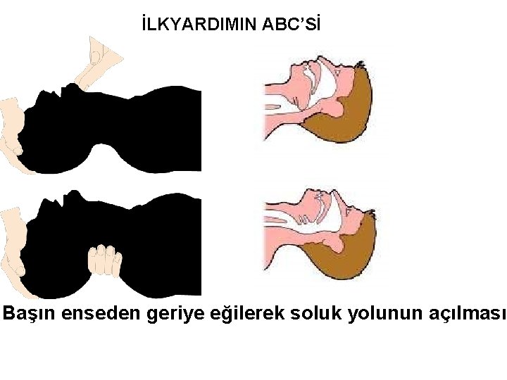 İLKYARDIMIN ABC’Sİ Başın enseden geriye eğilerek soluk yolunun açılması 