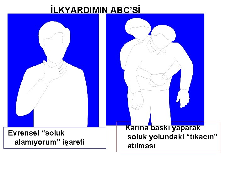 İLKYARDIMIN ABC’Sİ Evrensel “soluk alamıyorum” işareti Karına baskı yaparak soluk yolundaki “tıkacın” atılması 