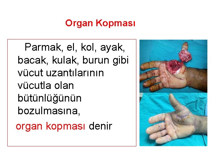 Organ Kopması Parmak, el, kol, ayak, bacak, kulak, burun gibi vücut uzantılarının vücutla olan
