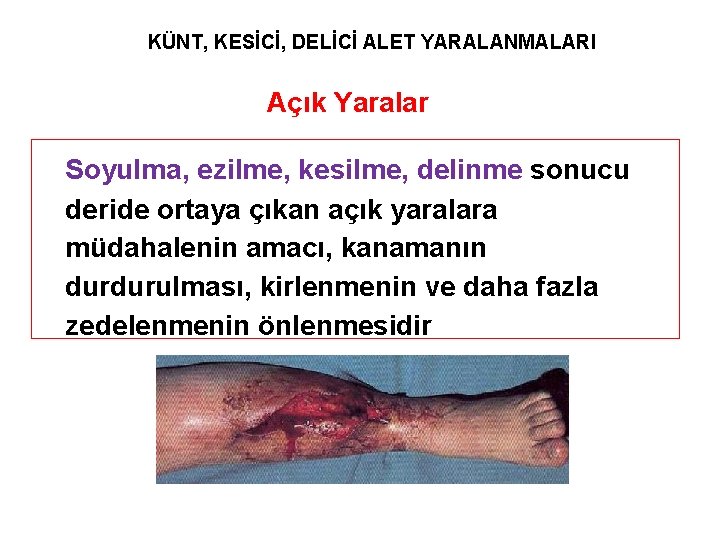 KÜNT, KESİCİ, DELİCİ ALET YARALANMALARI Açık Yaralar Soyulma, ezilme, kesilme, delinme sonucu deride ortaya