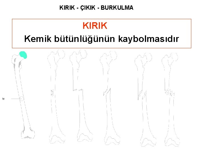 KIRIK - ÇIKIK - BURKULMA KIRIK Kemik bütünlüğünün kaybolmasıdır 