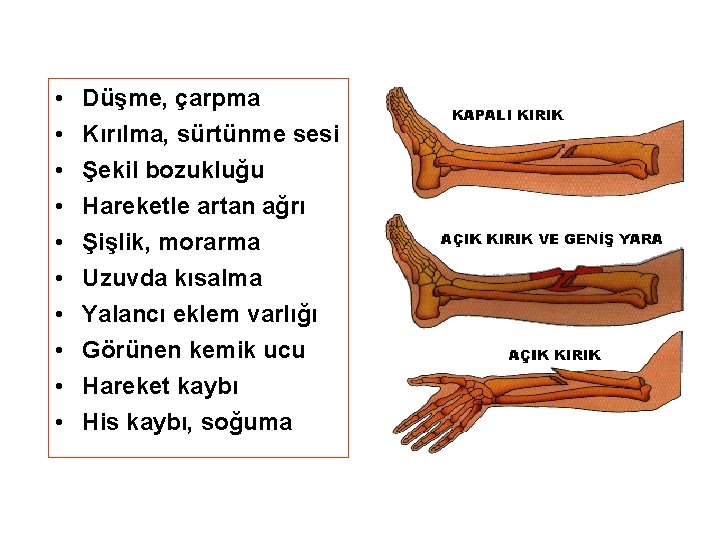  • • • Düşme, çarpma Kırılma, sürtünme sesi Şekil bozukluğu Hareketle artan ağrı