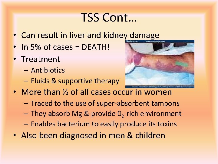 TSS Cont… • Can result in liver and kidney damage • In 5% of