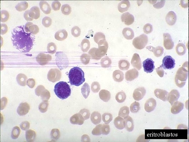 eritroblastos 