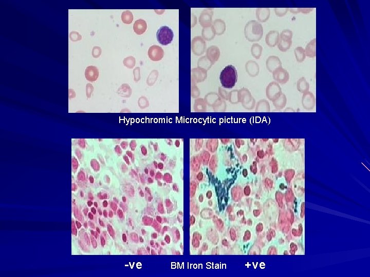 Hypochromic Microcytic picture (IDA) -ve BM Iron Stain +ve 