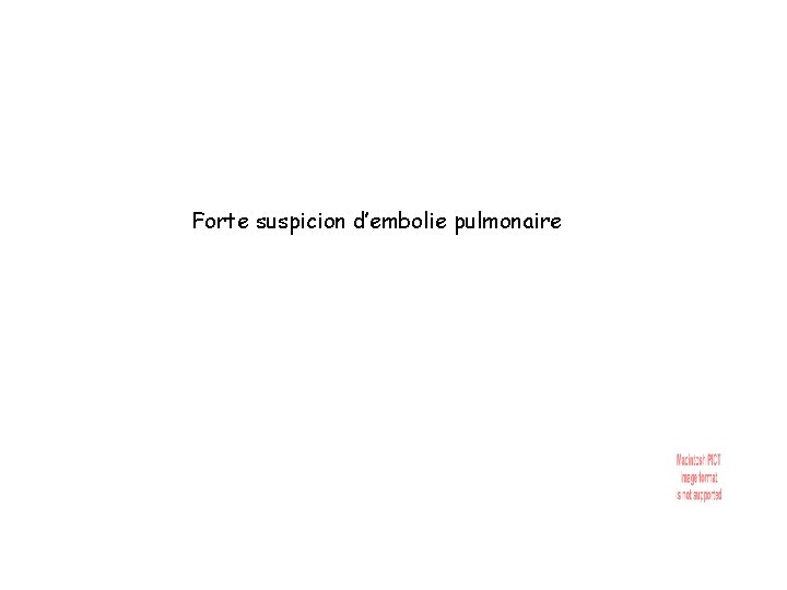 Forte suspicion d’embolie pulmonaire 