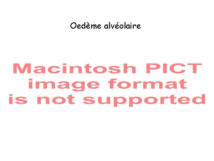 Oedème alvéolaire 