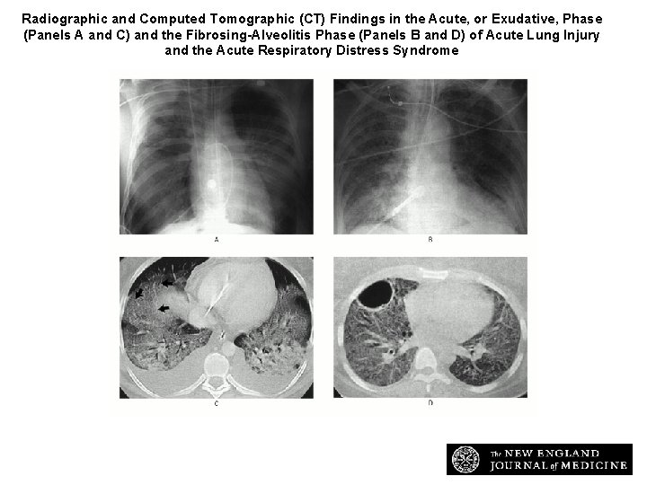 Radiographic and Computed Tomographic (CT) Findings in the Acute, or Exudative, Phase (Panels A