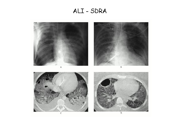 ALI - SDRA 