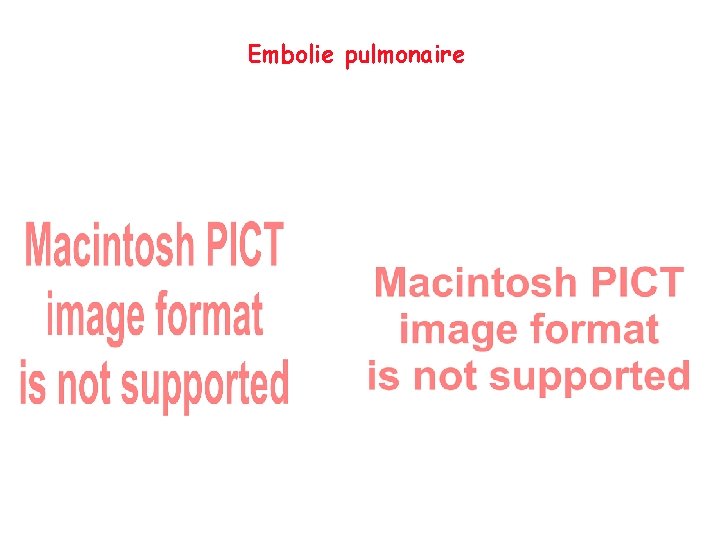 Embolie pulmonaire 