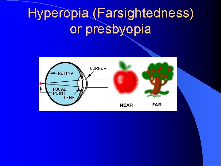 Hyperopia (Farsightedness) or presbyopia 