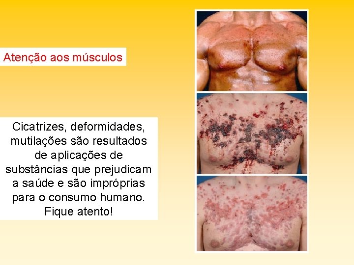 Atenção aos músculos Cicatrizes, deformidades, mutilações são resultados de aplicações de substâncias que prejudicam