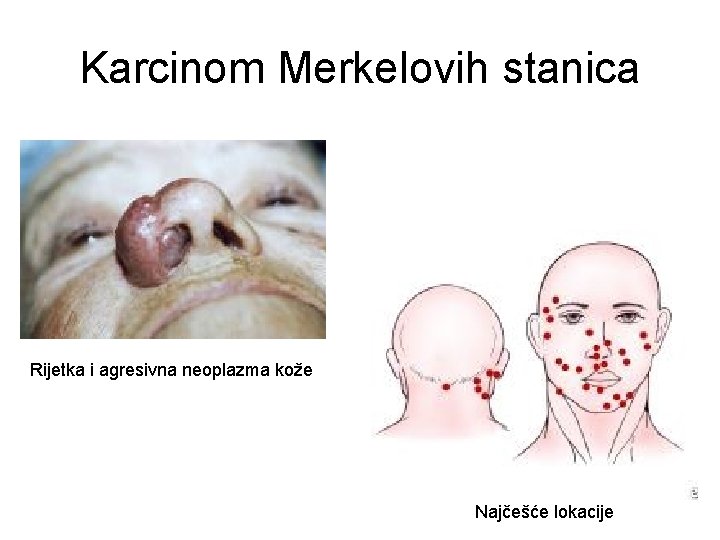 Karcinom Merkelovih stanica Rijetka i agresivna neoplazma kože Najčešće lokacije Karcinom Merkelovih stanica Rijetka i agresivna neoplazma kože Najčešće lokacije