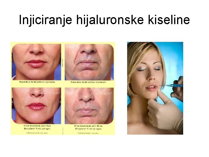 Injiciranje hijaluronske kiseline 