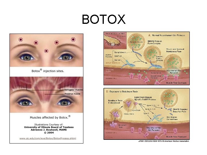 BOTOX 