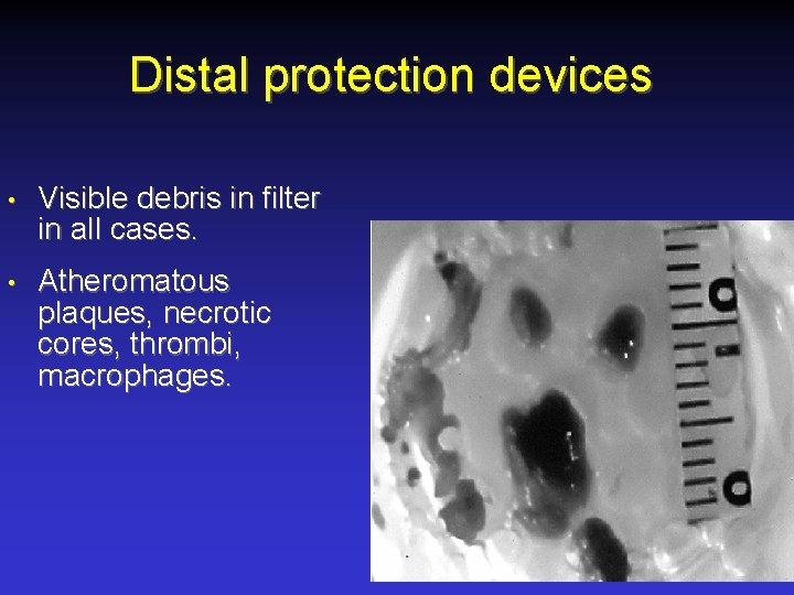 Distal protection devices • Visible debris in filter in all cases. • Atheromatous plaques,