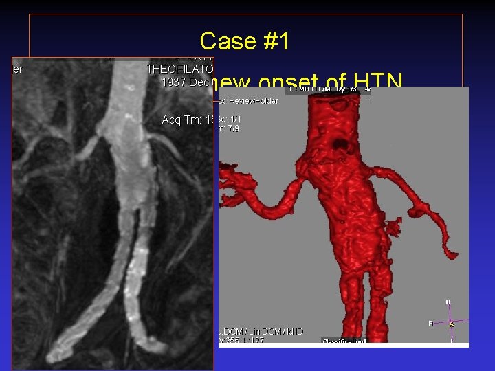 Case #1 S/p EVAR new onset of HTN 