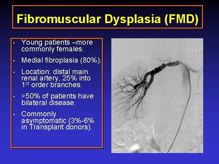 Fibromuscular Dysplasia (FMD) • Young patients –more commonly females. • Medial fibroplasia (80%). •