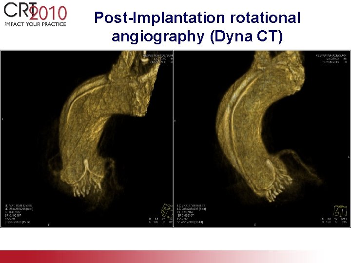 Post-Implantation rotational angiography (Dyna CT) 