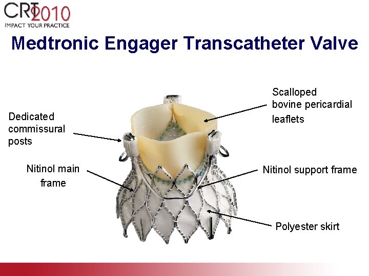 Medtronic Engager Transcatheter Valve Dedicated commissural posts Nitinol main frame Scalloped bovine pericardial leaflets