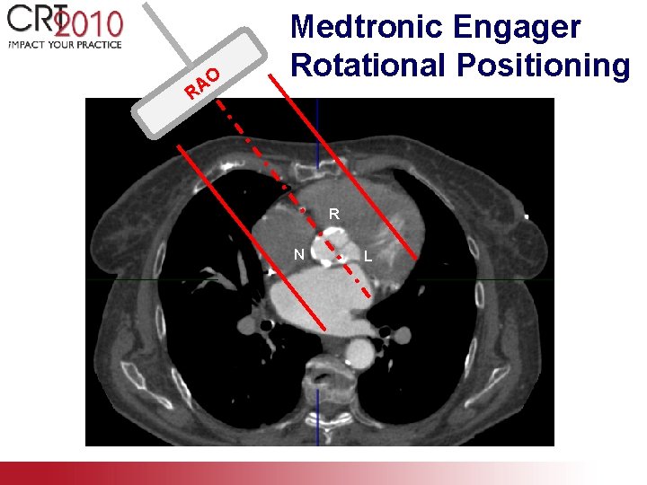 O A R Medtronic Engager Rotational Positioning R N L 
