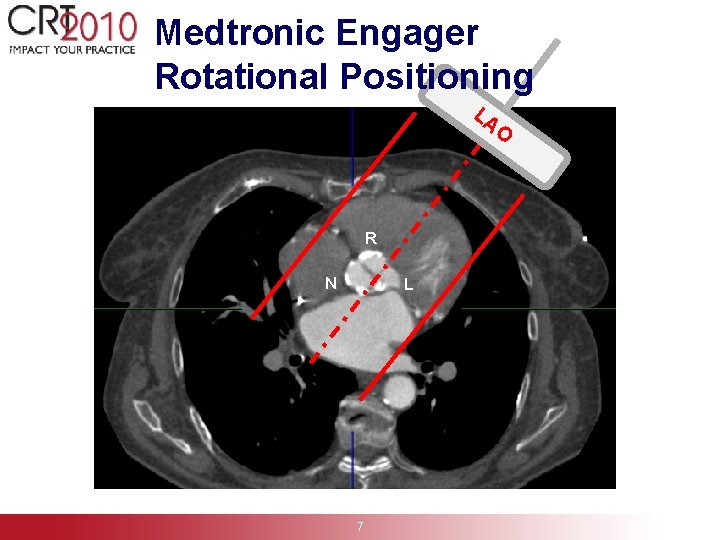 Medtronic Engager Rotational Positioning LA O R N L 7 