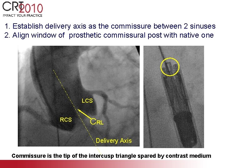 1. Establish delivery axis as the commissure between 2 sinuses 2. Align window of