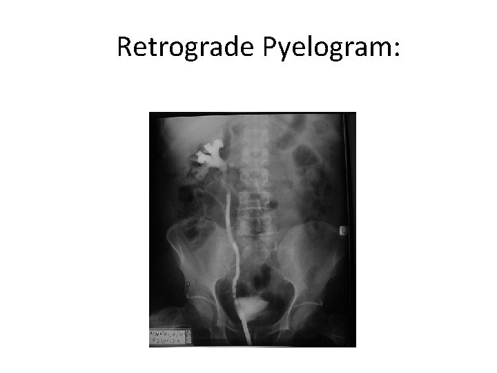 Retrograde Pyelogram: 