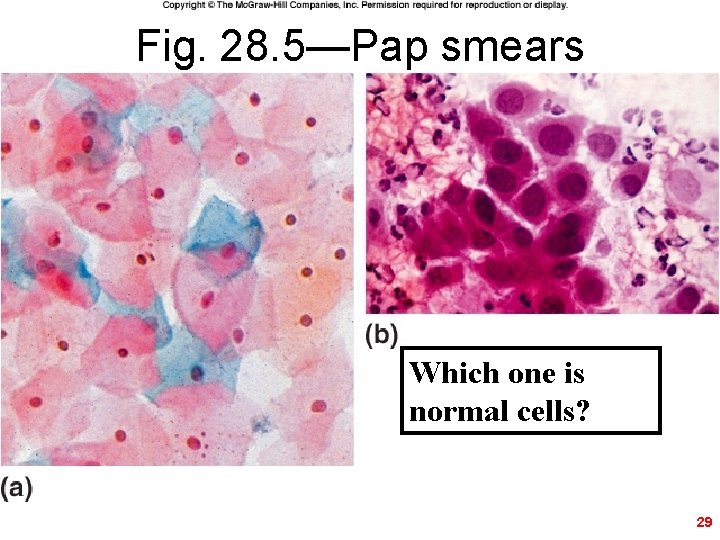 Fig. 28. 5—Pap smears Which one is normal cells? 29 