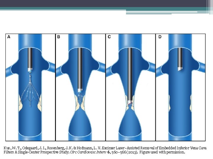 Excimer Laser–Assisted Removal Kuo, W. T. , Odegaard, J. I. , Rosenberg, J. K.