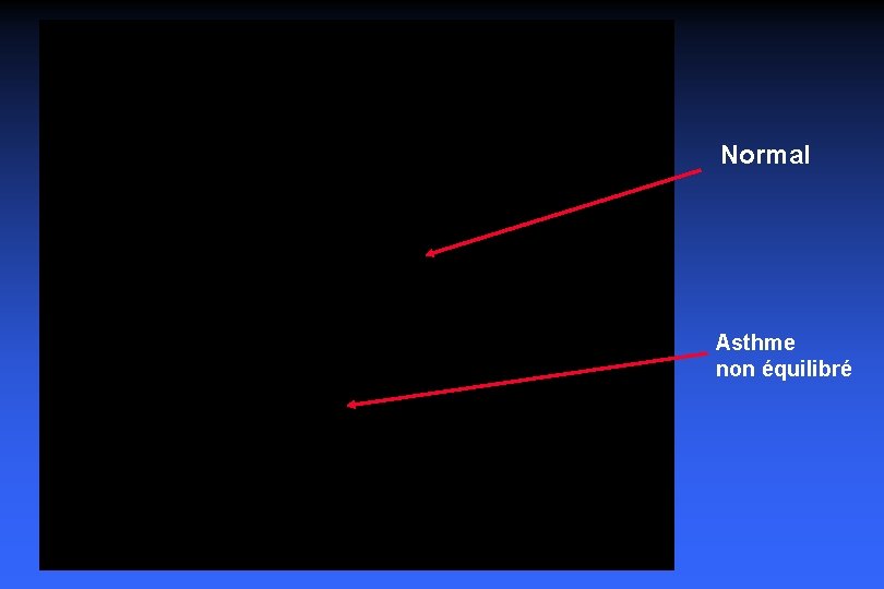 Normal Asthme non équilibré 