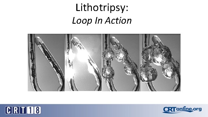 Lithotripsy: Loop In Action 