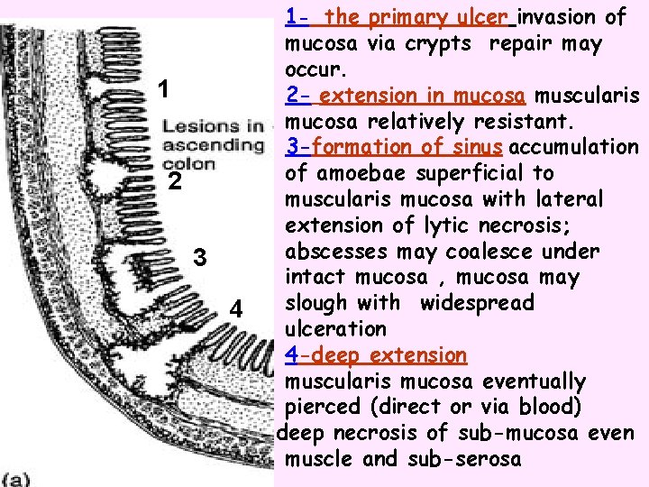 1 2 3 4 1 - the primary ulcer invasion of mucosa via crypts