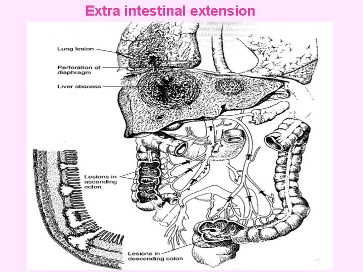 Extra intestinal extension 