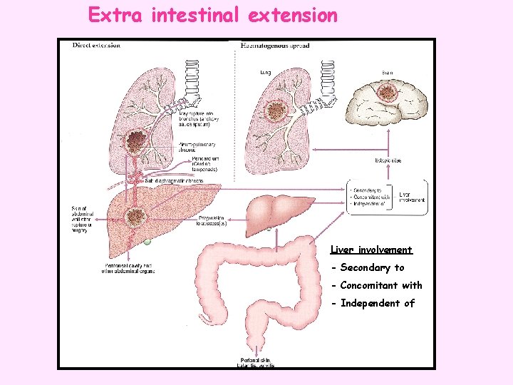 Extra intestinal extension Liver involvement - Secondary to - Concomitant with - Independent of