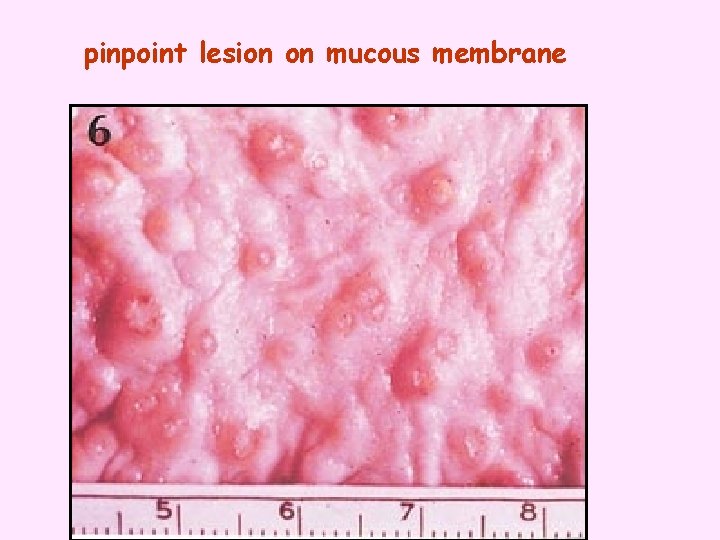 pinpoint lesion on mucous membrane 