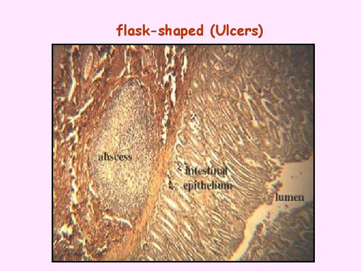 flask-shaped (Ulcers) 