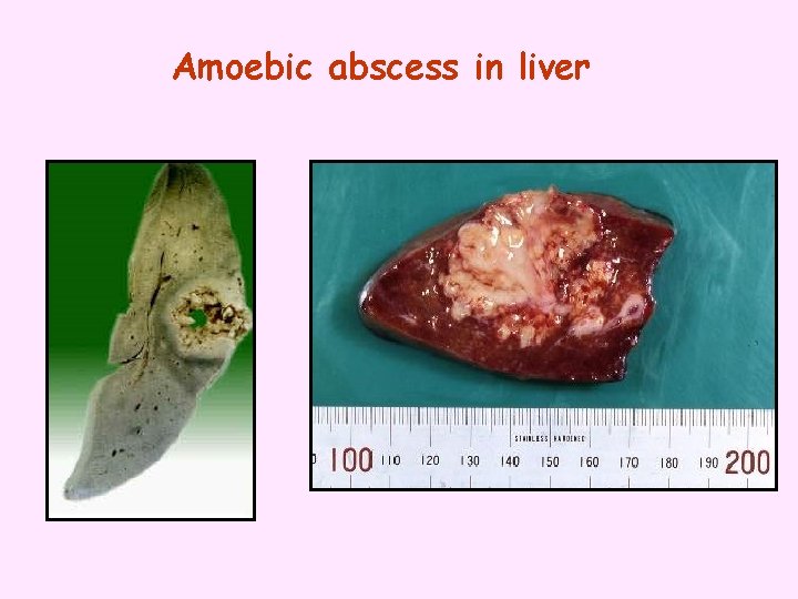 Amoebic abscess in liver 