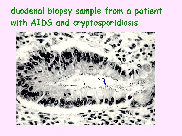 duodenal biopsy sample from a patient with AIDS and cryptosporidiosis 