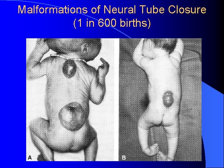 Malformations of Neural Tube Closure (1 in 600 births) 