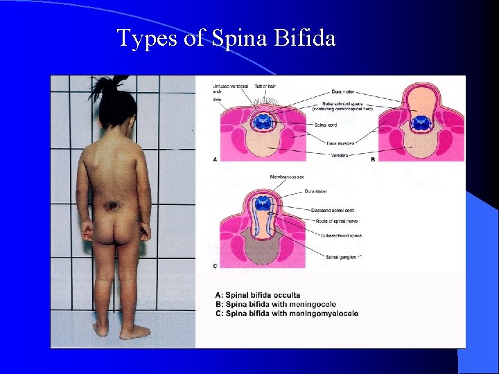 Types of Spina Bifida 