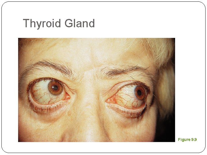 Thyroid Gland Figure 9. 9 